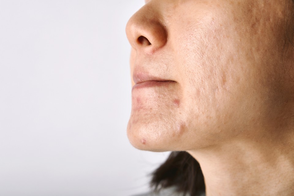 skin-problem-with-acne-diseases-5BEB89K.jpg